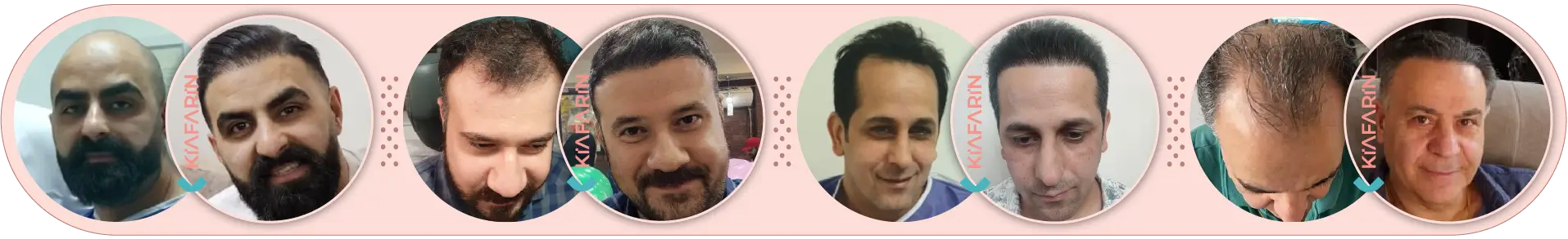 نمونه کار کاشت مو
