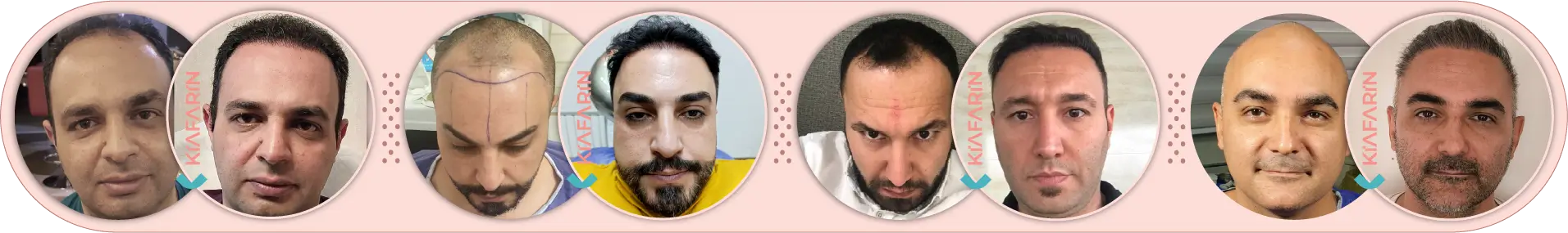 نمونه کار کاشت مو