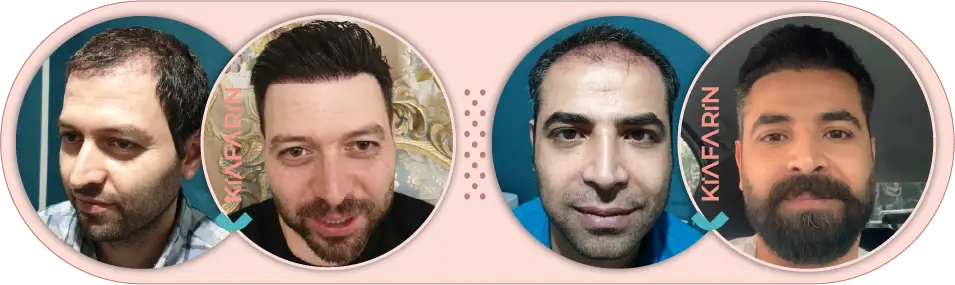 نمونه کارکاشت مو