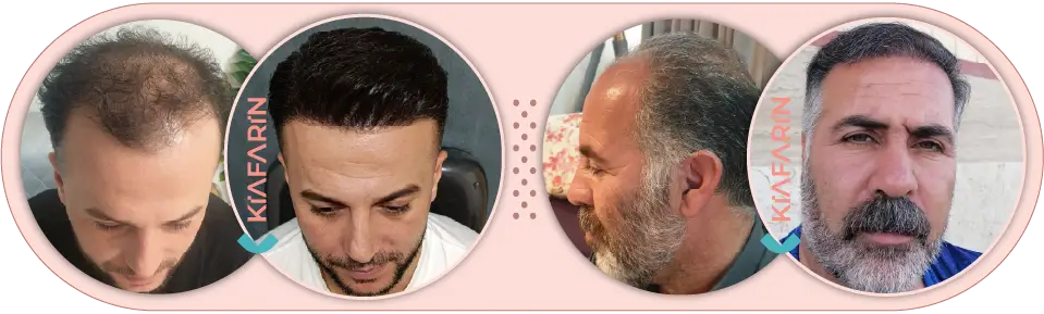 نمونه کار کاشت مو