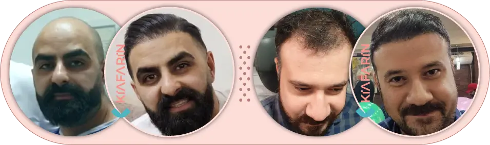 نمونه کار کاشت مو