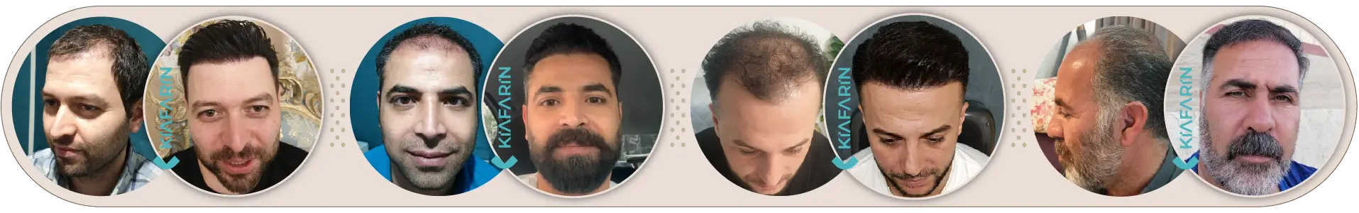 نمونه کار کاشت مو