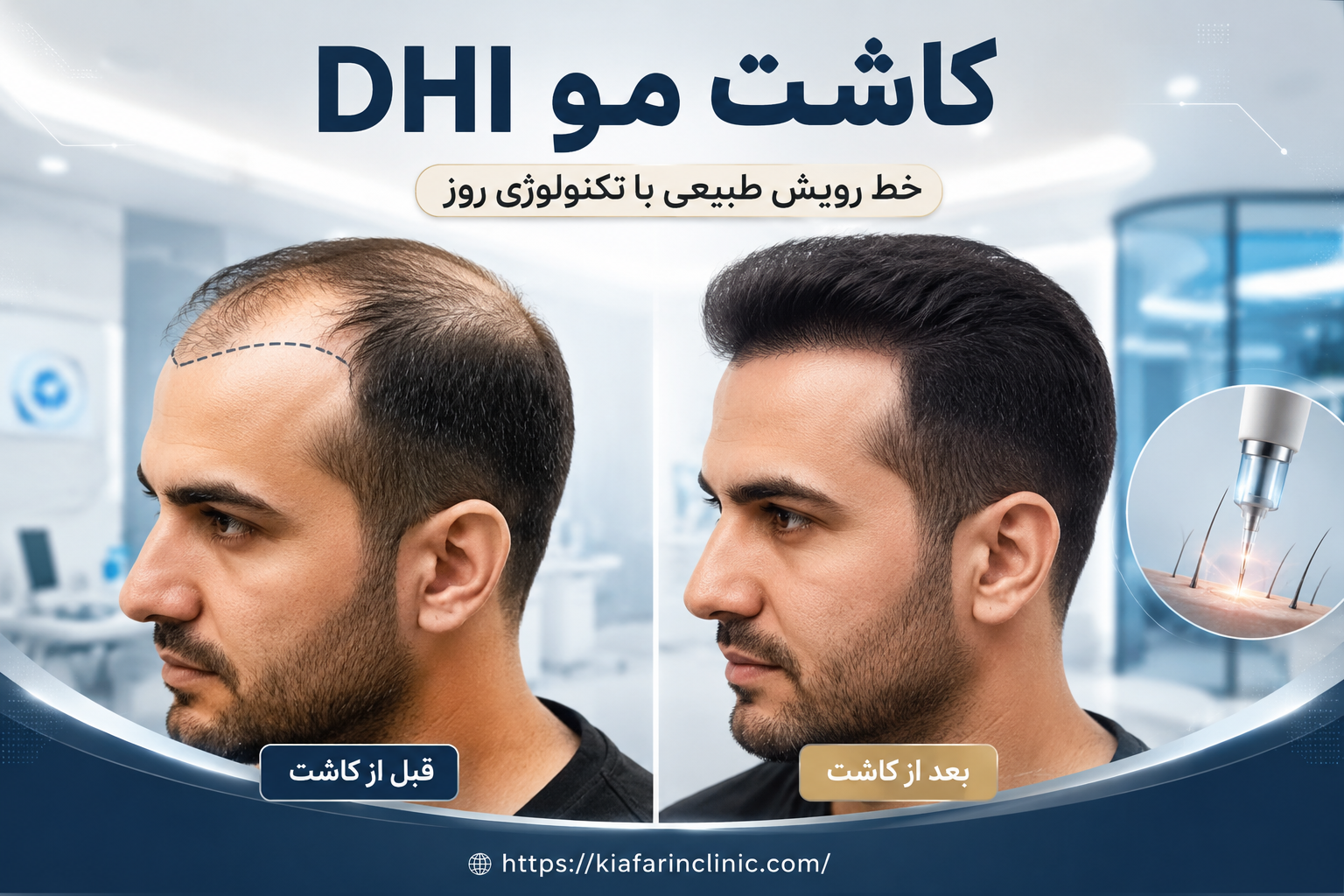 کاشت مو DHI