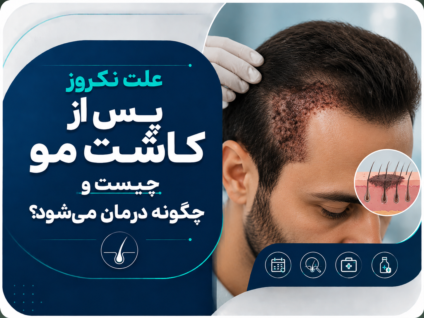 علت نکروز پس از کاشت مو چیست و چگونه درمان می‌شود؟